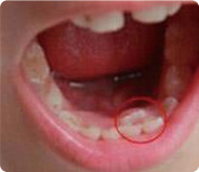 儿童口腔常见疾病