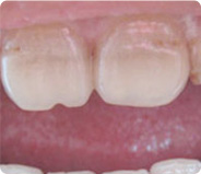 牙齿美学修复适用症状