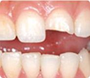 牙齿美学修复适用症状