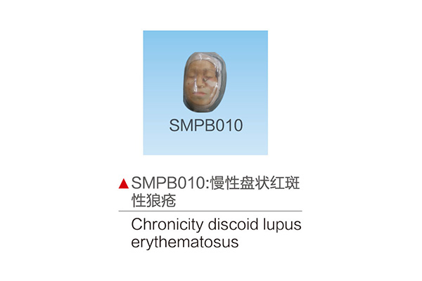 SMPB010    慢性盘状红斑性狼疮