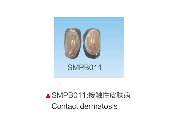 SMPB011       接触性皮肤病