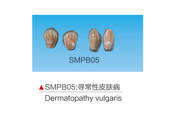 SMPB05 Dermatopathy vulgaris
