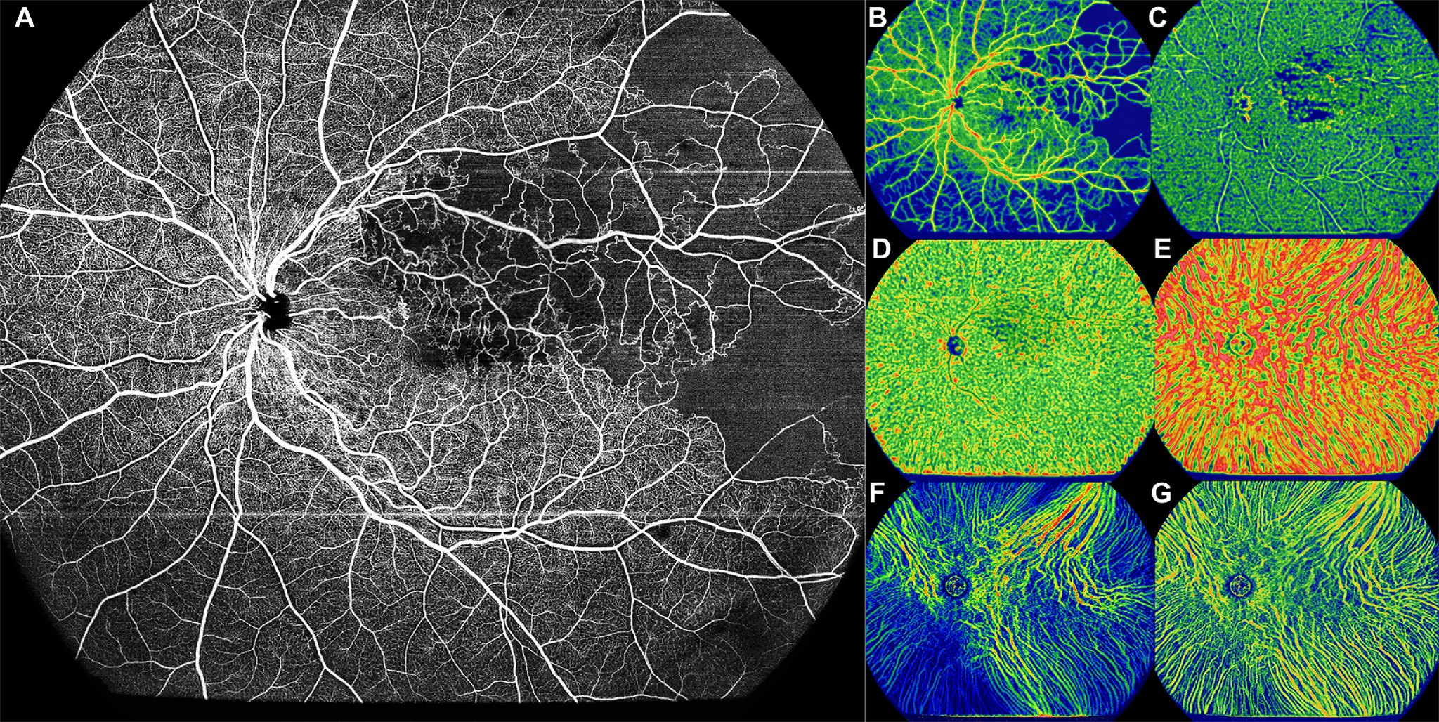Central and Peripheral Changes Found in Both RVO Eyes and Unaffected Fellow Eyes
