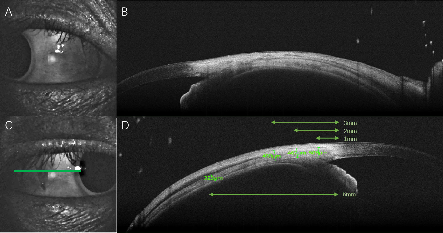 A Thicker Sclera Was Found In SLE Patients Even Without Scleritis by Using SS-OCT