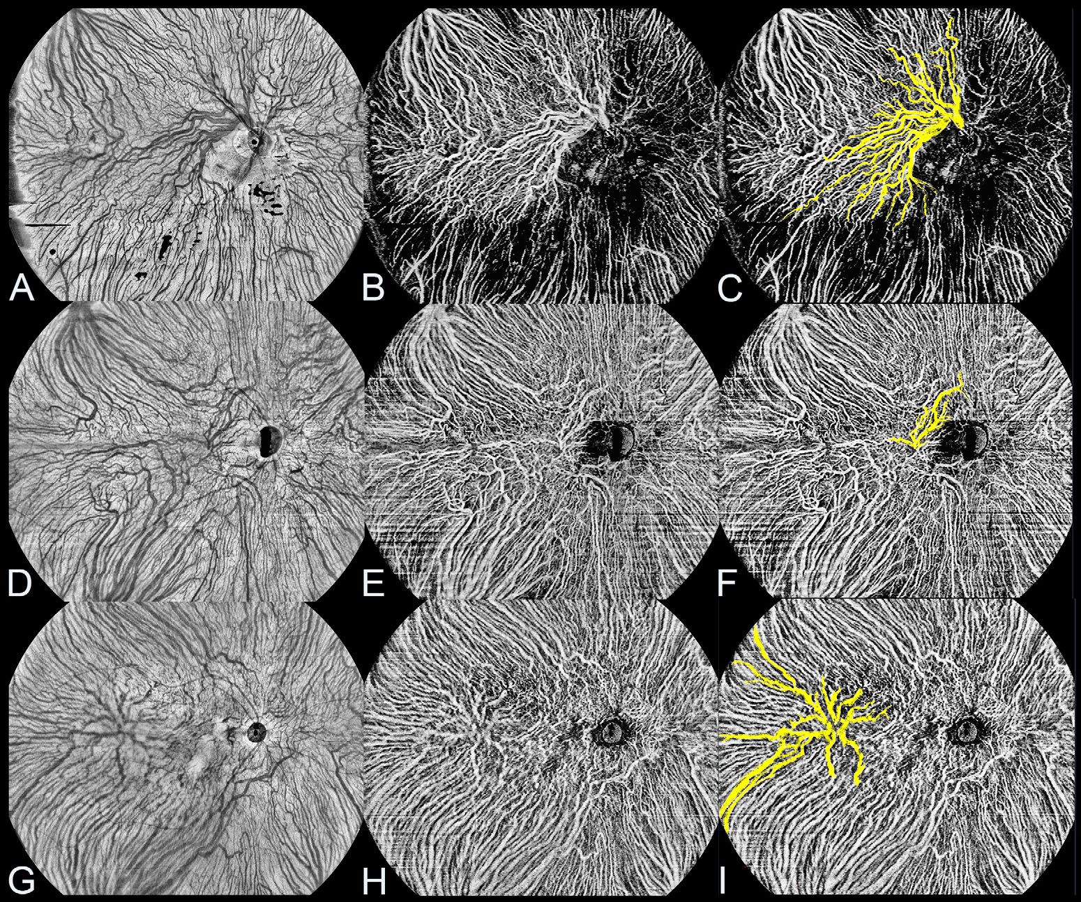Posterior Vortex Veins in Healthy Eyes Captured by Ultra-widefield OCTA