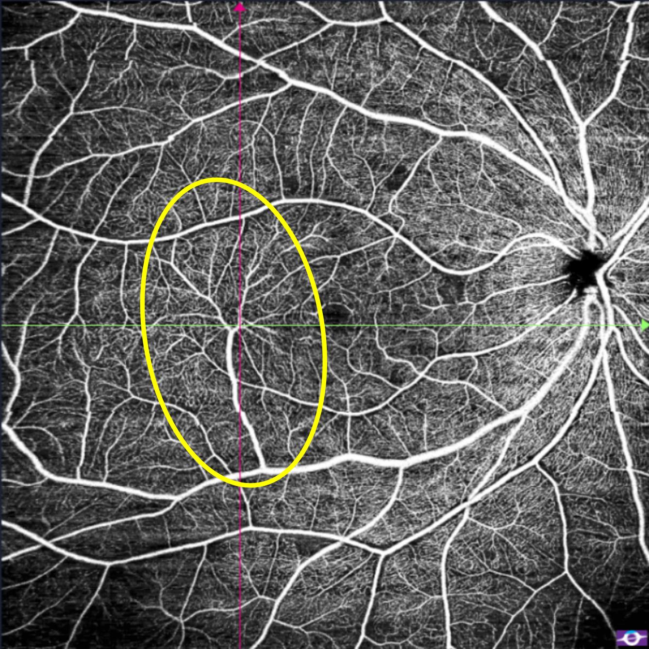 Congenital Retinal Microvessels, OCT Angiography