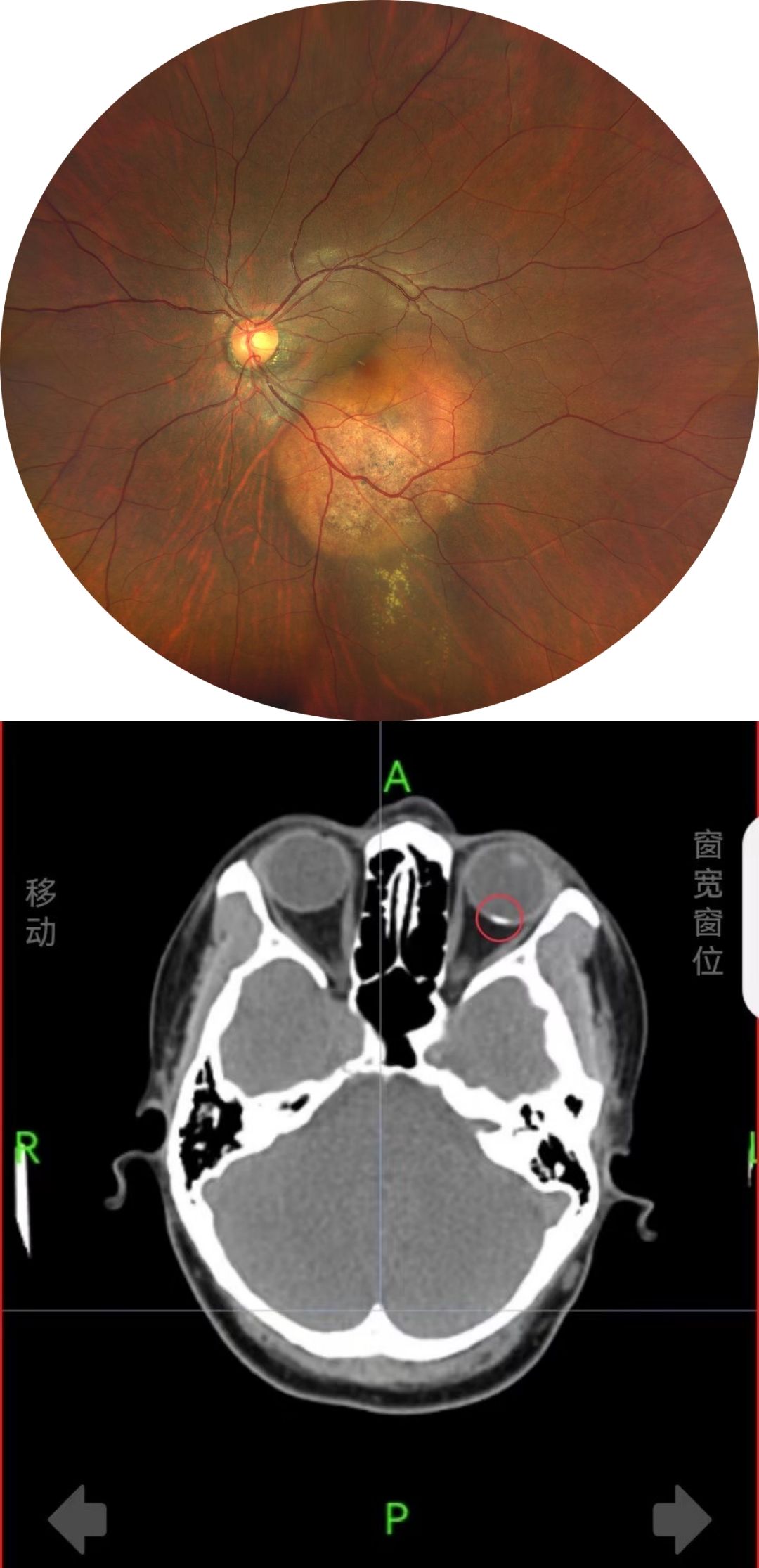 Choroidal Osteoma with Secondary CNV Captured with Full-range SS-OCTA
