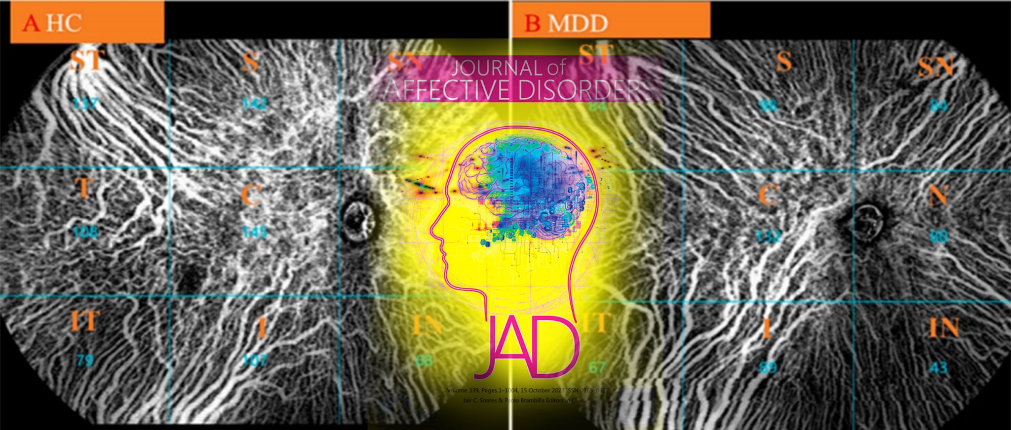 Major Depressive Disorder Exhibits Lower Choroidal Vessel Density