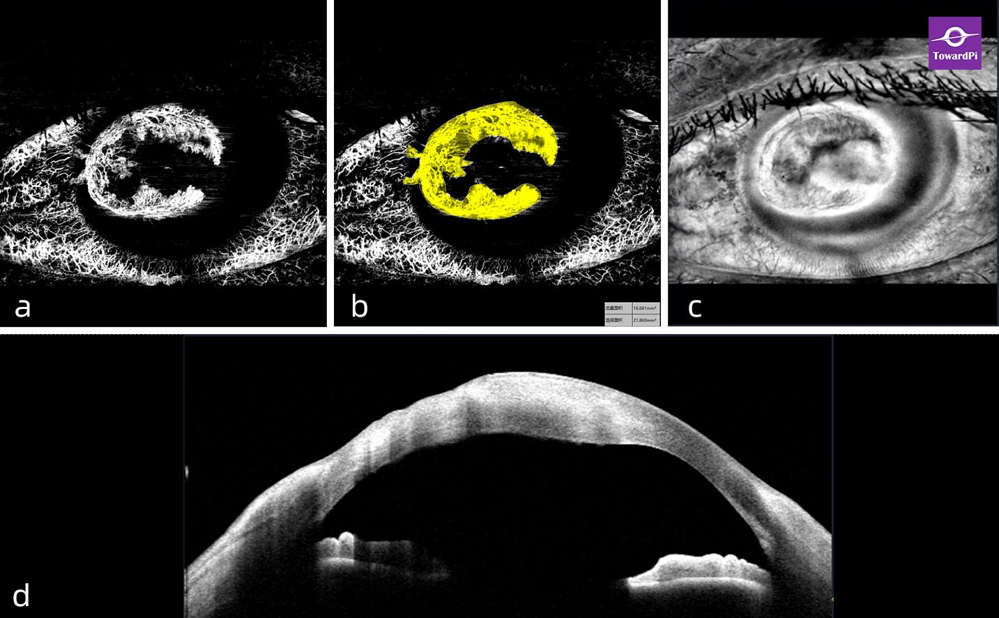 Virus Keratohelcosis with Secondary Corneal Neovascularization Captured by AS-OCTA