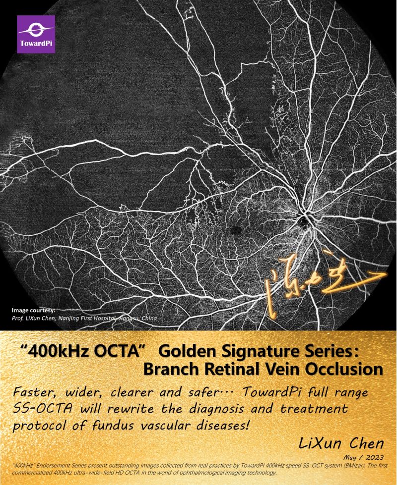 Branch Retinal Vein Occlusion, BRVO, OCTA Single Scan
