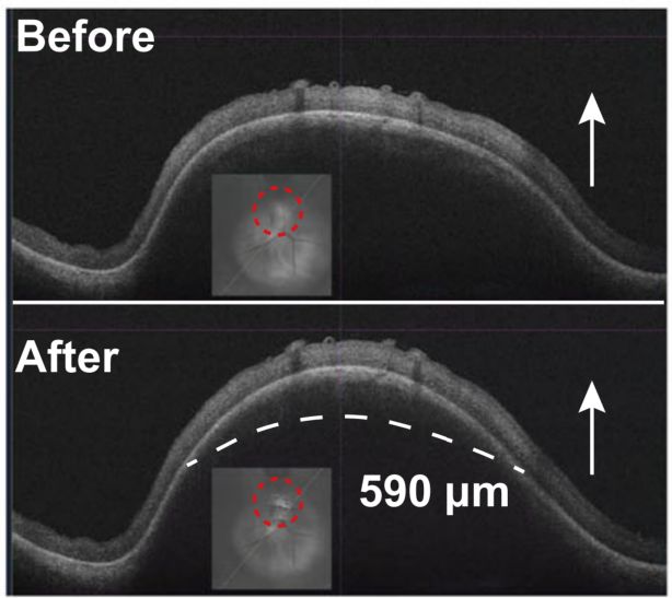 A Wireless Battery-free Eye Modulation Patch for High Myopia Therapy
