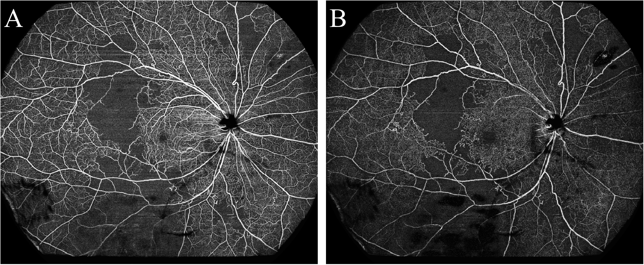 Vessel Density Changes and It Is Positively Correlated with Disease Activity in SLE Eyes