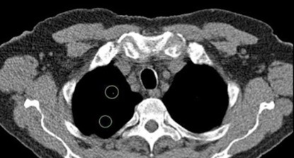Infervision’s InferRead CT Lung in Wake Radiology